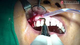 Woodpecker Ultrasurgery Application4Alveoloplasty at Right Maxillary Anterior [upl. by Adaha]