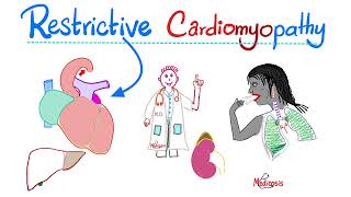 Restrictive Cardiomyopathy  Causes Symptoms Diagnosis amp Treatment  Cardiology Series [upl. by Linus]