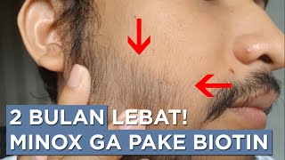 Progres Minoxidil 2 Bulan Tanpa Biotin [upl. by Petr229]