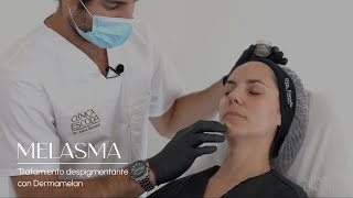 Tratamiento de melasma con Dermamelan [upl. by Roze]