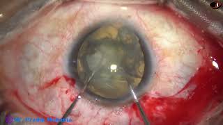 Managing a Cataract with Microcornea coloboma iris and weak zonule  Pradip Mohanta 12 Nov 2022 [upl. by Staten]