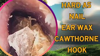 Hard as nails earwax vs cawthorne hook with ear wax removal [upl. by Ameg952]