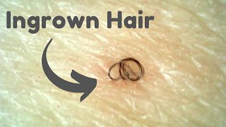 Ingrown Hair Removal Marathon Uncovering the Strangest Hairs Hidden Under the Skin [upl. by Ailimac]