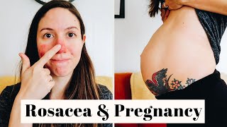 ROSACEA BENIGN PLACENTAL LAKES amp MORE  22 week pregnancy update [upl. by Lilias692]