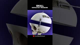 Skull distractor Procedure Animation [upl. by Aurore]