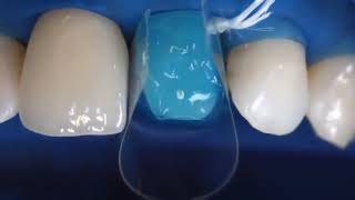 Ivoclar Vivadent Variolink N Kit Resin Cement How To Use  DENTBEAR [upl. by Mcknight]