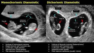 Fetal Twins Ultrasound Normal Vs Abnormal  MonochorionicDichorionicDiamnioticMonoamniotic USG [upl. by Zitah]