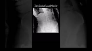 Spine movement seen for the FIRSTTIME with dynamic XRay backpain anatomy [upl. by Neelyk]