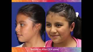 Domenica Before amp After Microtia Ear Surgery [upl. by Akamahs977]