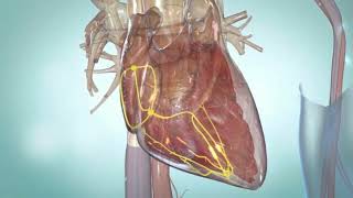 Premature Ventricular contraction PVCs [upl. by Leahey]