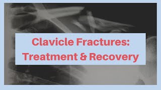 What is the treatment and recovery from a clavicle fracture [upl. by Carri]