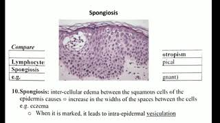 Histopathology 3 👉 acantholysis amp spongiosis amp ballooning [upl. by Enimaj24]