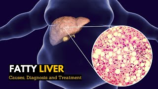 Fatty Liver Causes Signs and Symptoms Diagnosis and Treatment [upl. by Sadye]