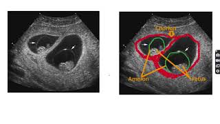 Anatomy of monochorionic diamniotic twin pregnancy twin anatomy pregnancy twinpregnancy [upl. by Peltier]