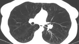 Subxiphoid Uniportal Lung Volume Reduction Surgery  Computed Tomography Scan [upl. by Durwood]