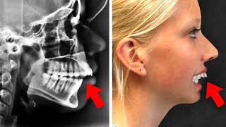 How to CORRECT Excessive OverbiteOrthodontic Options [upl. by Aidnama]