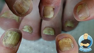 BEST TREATMENT FOR YOUR TOENAIL FUNGUS FOOT HEALTH MONTH 2018 20 [upl. by Mady]