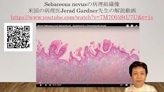 sebaceous nevusの病理組織像の解説 [upl. by Doerrer963]