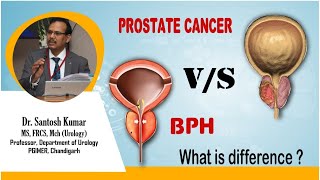 BPH Prostate Enlargement and Prostate Cancer DrProfSantosh Kumar PGI [upl. by Dagna]