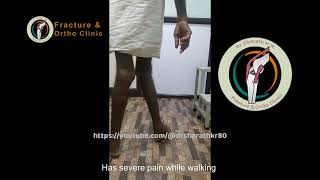 Valgus deformity of knee correction  post surgery walking within one week [upl. by Ellon]