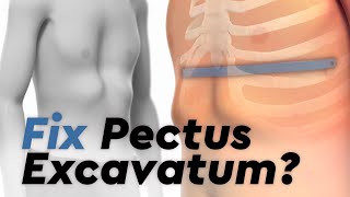 Pectus Excavatum and the Nuss Procedure [upl. by Elbon]