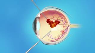 Proliferative Diabetic Retinopathy Tractional Retinal Detachment Vitreous Hemorrhage [upl. by Kcerb989]