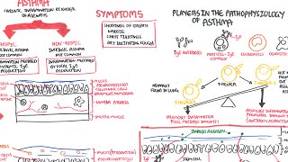 Asthma  signs and symptoms pathophysiology [upl. by Siravart]