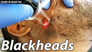 Worst Cystic Acne Biggest Blackheads and GIANT Cyst Removal [upl. by Sinclair538]