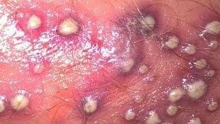 Worst Pimples I Have EVER Seen Pimple Popping amp Zit Removal [upl. by Alcott]