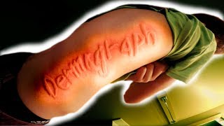 RARE SKIN DISORDER YOU CAN DRAW PICTURES ON HIS SKIN Dermatographia [upl. by Plerre]