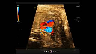 Ecocardiografía fetal Arteria subclavia derecha aberrante explicada paso a paso [upl. by Mamoun95]