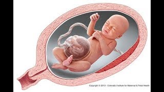 How to Omphalocele  causes symptoms diagnosis treatment pathology [upl. by Alyacim]