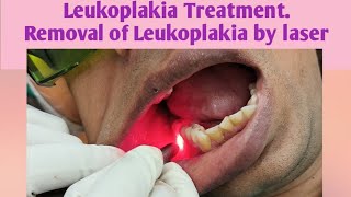 Leukoplakia TreatmentRemoval of Leukoplakia by laser SurgeryHow to remove Leukoplakia by lasersurg [upl. by Ycnej]