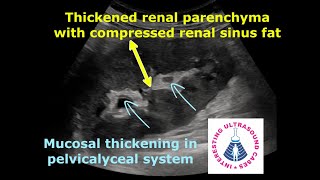 PYELONEPHRITIS ON ULTRASOUND  4 Different Cases  Emphysematous pyelonephritis [upl. by Gilbertson662]