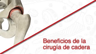 Beneficios de una cirugía de cadera  Técnica AMIS [upl. by Collis883]