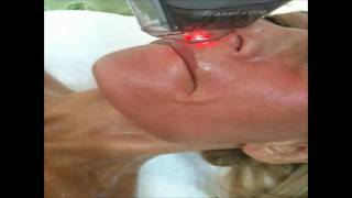 Smokers lip lines fraxel laser treatment Sydney [upl. by Merv]