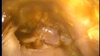 中耳炎膽脂瘤珍珠瘤手術後 Mild otorrhea middle ear cavity post cholesteatoma op 劉耿僚醫師 [upl. by Goldia]