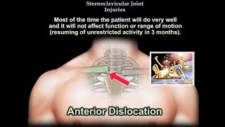 Sternoclavicular Joint Injuries  Everything You Need To Know  Dr Nabil Ebraheim [upl. by Uela]