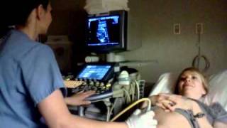 Baby heartbeat Fetal Ultrasound [upl. by Lamahj]