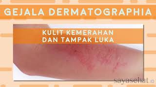 Dermatographia [upl. by Blunt961]