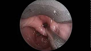 Zenkers Diverticulum Prior to Endoscopic Repair [upl. by Akinom]