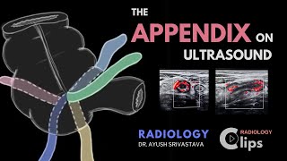 The Appendix on ultrasound and Acute appendicitis  Radiology [upl. by Ara173]