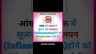 What is Blepharitis health healthknowledge nursingstudent medicalstudent blepharitis [upl. by Eirotal131]