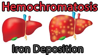 Hemochromatosis Easy explained symptoms causes treatment prognosis [upl. by Aimekahs432]