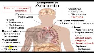 MICROCYTIC HYPOCHROMIC ANEMIA 4TH YR [upl. by Beatty]