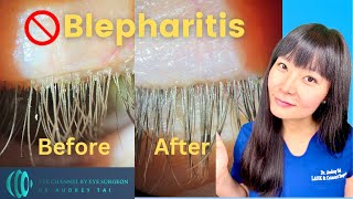 Best Blepharitis Treatments at Home  Simple amp Effective  Step by Step Guide Eye Surgeon Explains [upl. by Daune]