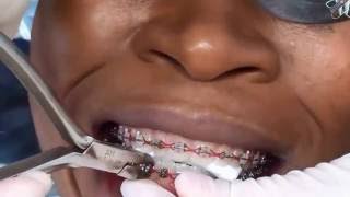 removing braces orthodontic [upl. by Naened]