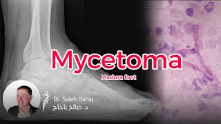 13 Mycetoma Madura foot [upl. by Asilanna232]