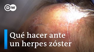 Primero varicela luego herpes zóster [upl. by Vial787]