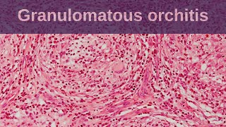 Idiopathic Granulomatous Orchitis  Pathology mini tutorial [upl. by Nylarak]